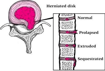 Herniated Disk Cause of Injury Caused by abnormal stresses