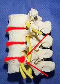Herniated Nucleus Pulposus (HNP) of the Lumbar Spine Displacement of the