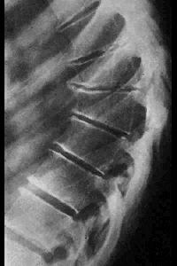 Scheuermann s Disease Dx made by X-ray 45 degrees With 5