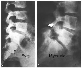 Low Back Pain Spondylolysis Defect in pars interarticularis