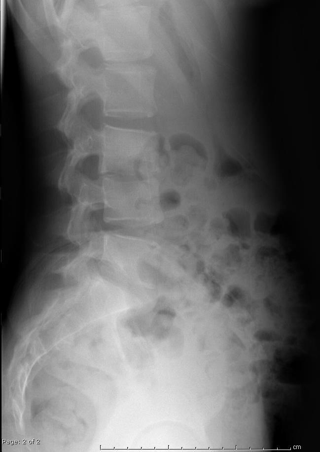 Osteovertebral Diskitis Radiographs may be normal initially Disk space