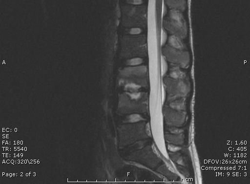 evident Contrast enhanced MRI helpful Parenteral anti Staph aureus for