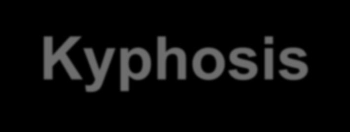 Scheuermann Kyphosis Anterior wedging of 3 consecutive vertebrae with kyphotic