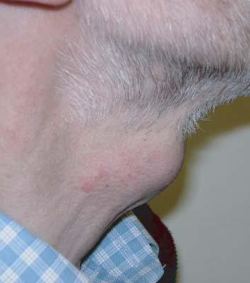 Thyroid masses Majority are benign, but need to be concerned