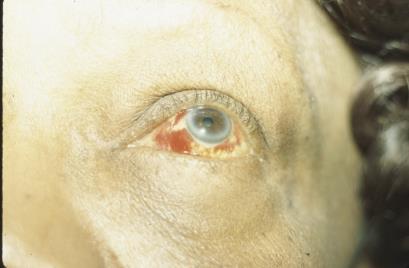 Injection Subconjunctival Injection Contraindications Medication Hypersensitivity Active Scleritis