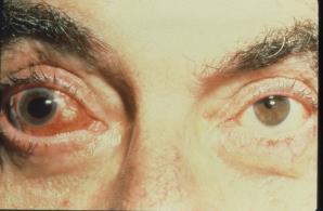 Proptosis CRVO/CRAO Optic Atrophy EOM Palsies Ptosis Pupillary Abnormalities Elevated IOP Globe Perforation Systemic Side Effects (Respiratory Arrest, Cardiovascular and CNS Toxicity) Intravitreal