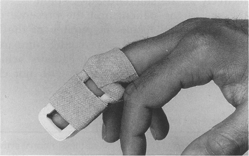 This study compares the effectiveness of this simple splint with that of the standard Stack splint in the management of mallet finger. MATERIALS AND METHODS Materials.
