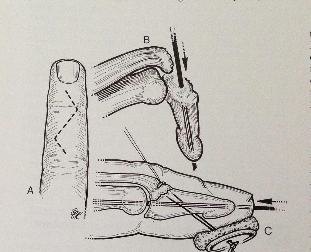 Mallet Finger Surgery Indicated for fractures with