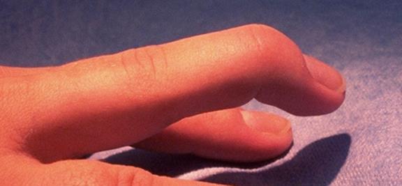 Symptoms What do mallet finger injuries look and feel like?