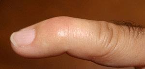 PIP joint (middle knuckle) extends, the finger may develop a