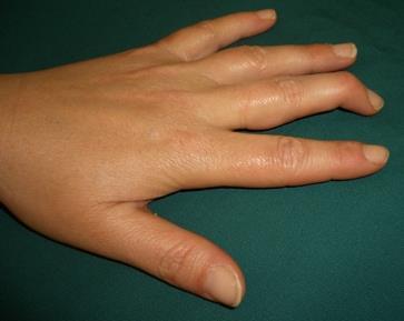 Or if Mallet finger is left untreated it at times can turn into