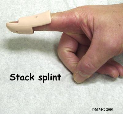 Usually continuous splinting for six weeks followed by six weeks of nighttime splinting will result in satisfactory healing and allow the