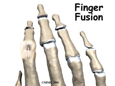 Surgery continue Finger Joint Fusion If the damage cannot be repaired using pin fixation, finger joint fusion may be needed.