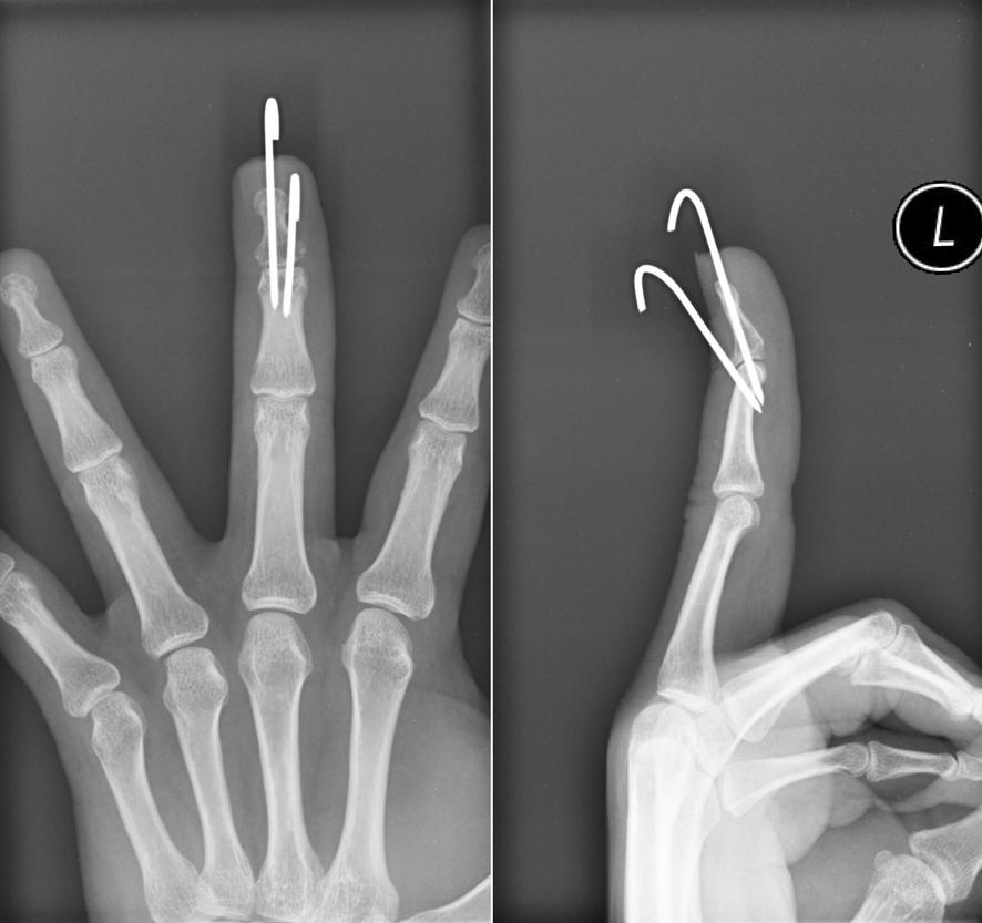 Subsequently, patient was subjected to physiotherapy with mobilization of the distal interphalangeal joint.