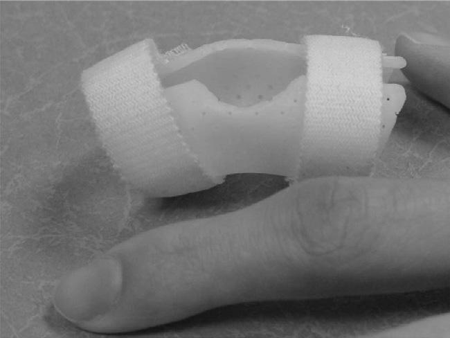 SPORTS RELATED HAND INJURIES Figure 1. The palmer extension block splinting at a 30 flexion of proximal interphalangeal joint. Figure 2.
