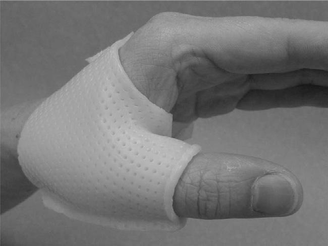 Seven patients with Mallet finger deformity (all males aged 19 47 years old, M = 30) were reviewed. There were three ring finger and four little finger injuries.