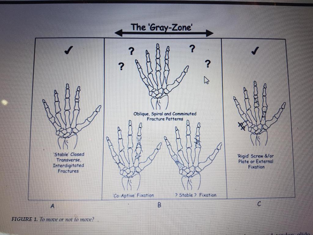 The Early motion Gray- Zone Feehan (2003) Fractures types either side of the Gray zone must move early