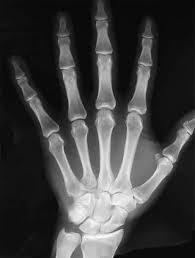 Hand Fractures (distal to carpus) Soft tissue injury with an underlying bone injury