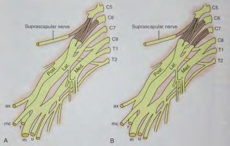 Lateral cord / MCN elbow flexion SCN shoulder ER UT posterior