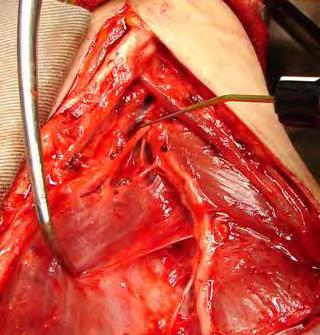 brachialis muscle Nerve