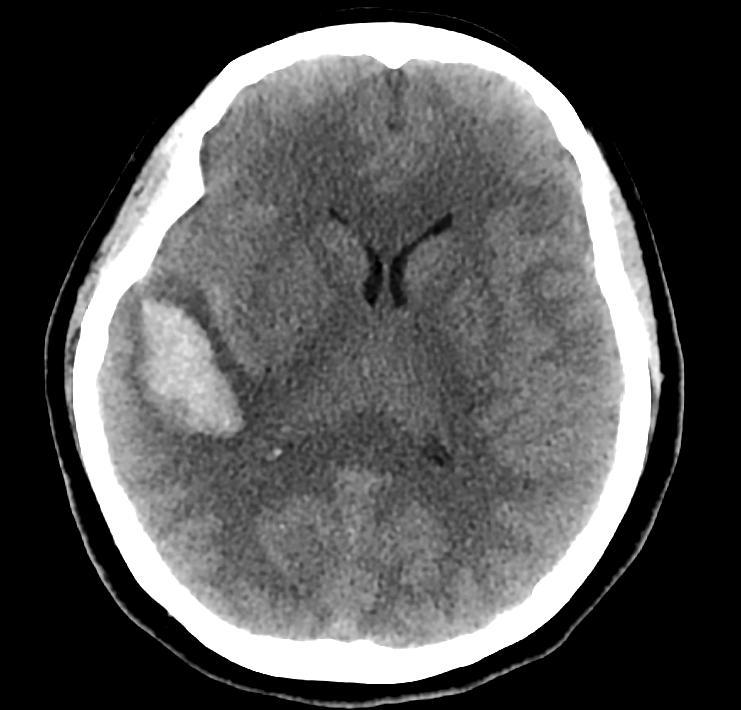 48 year old headache, left hemiparesis Lobar hemorrhage Choice between CTA and MRI/MRA Location was