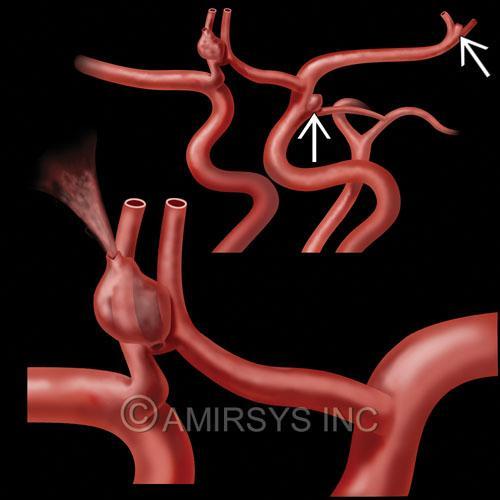 Typical aneurysm results from focal vascular wall weakening Typical