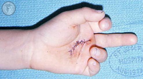Inspection for Wounds/Scars Note size and location of any acute wounds Can often predict likelihood of tendon damage