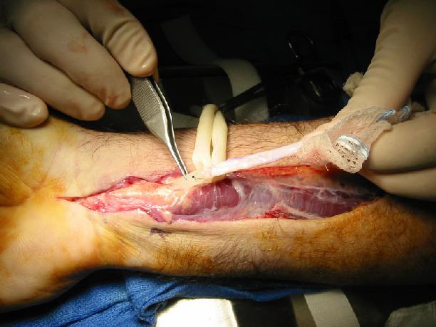 Flexor Tendon Reconstruction (Failed Repair) Two stage Silicone rod insertion and pulley