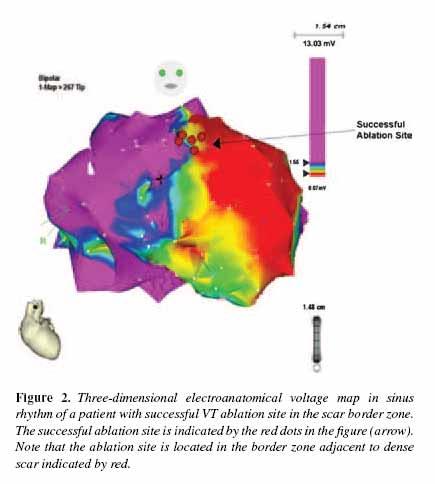 CAFCAA 2008 Relationship Between Successful Ablation Sites and the Scar Border Zone