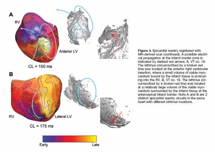 Ischemic VT Substrate CAFCAA 2008 Magnetic Resonance Based Anatomical Analysis