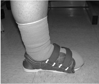 Football Dressing for Neuropathic Forefoot