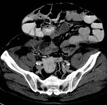 visible or palpable CT for detection of unsuspected sites, in obese patients Internal: less common, herniation of