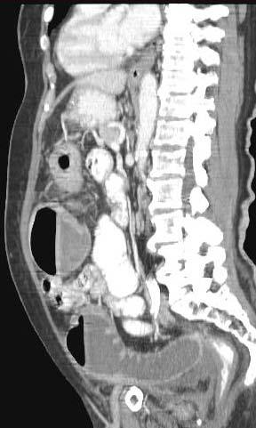 (predominantly venous disease) Prestenotic overdistension CT findings: Bowel wall thickening >3