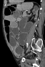 unidentified on CT (diagnosis