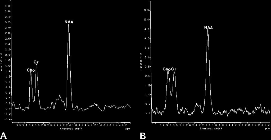AJNR: 18, August 1997 LIPID CONTAMINATION 1355 Fig 5. Proton MR spectroscopy of human brain adjacent to retroorbital fat (STEAM: TE of 135, repetition time of 1600).