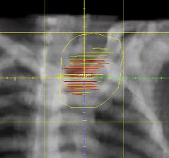 Patient Tumor Volume PET/CT Volume Irradiated PET/CT Lung V20 PET/CT Comments 1 3.25 1.25 1.11 unsuspected chest wall disease on PET 2 5.52 1.52 1.45 unsuspected supraclavicular node on PET 3 5.05 1.