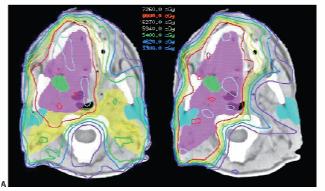 5 indicates positive for cancer Region determined by PET, extent by CT From Koshy, Paulino, Howell et al., Head & Neck, 27:6 494-502, 2005.
