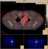 PET-CT Image Registration Hybrid PET-CT Scanner Combined helical, multislice CT scanner
