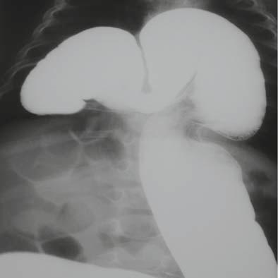 Bilateral congenital Morgagni-Larrey's hernia 22.7 months (range: 28 days to 9 years). All except two sustained repeated attacks of pneumonia, in whom hernia was discovered at surgery. In 5 (62.