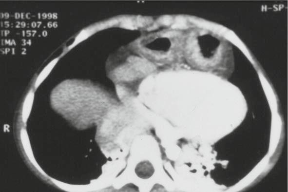Retrospectively, there was evidence of bilateral CMLH on CT scan of the chest (Fig. 5) as part of the left lobe of the liver herniated through the right defect.