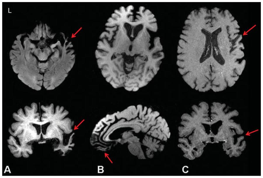 Risacher and Saykin Page 46 Fig. 3. Atrophy in frontotemporal dementia (FTD) subtypes.