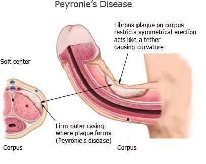 How Do I Know If I Have Peyronie s Disease? The common symptoms of Peyronie s disease can start suddenly or develop gradually over time.