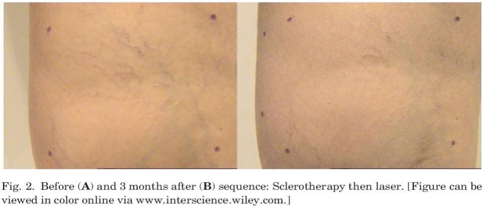 This study aims to compare a long pulsed Nd:YAG laser with contact cooling to sclerotherapy for treating small diameter leg telangiectasias by evaluating objective clinical effects.