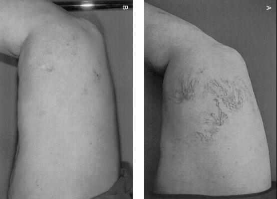 METHODS Ten female patients (mean age of 39 years) had a 5-cm2 area of veins measuring 0.