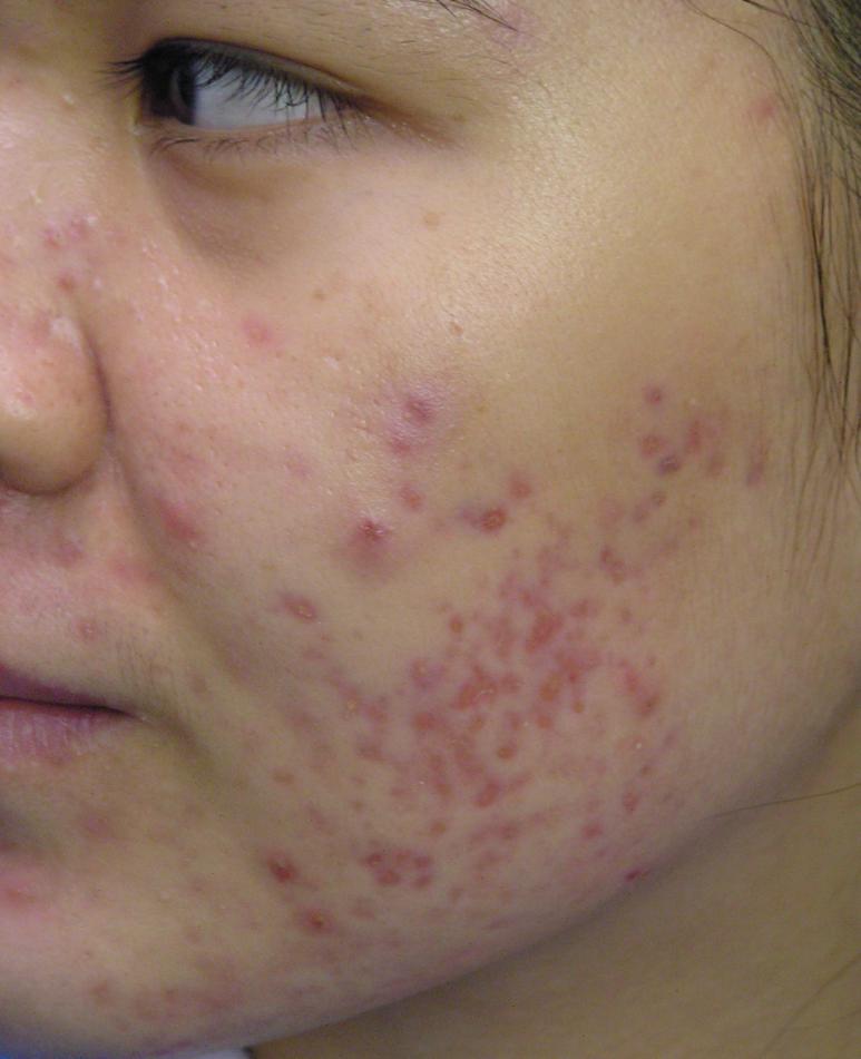 Acne redness 5 treatments @ 1