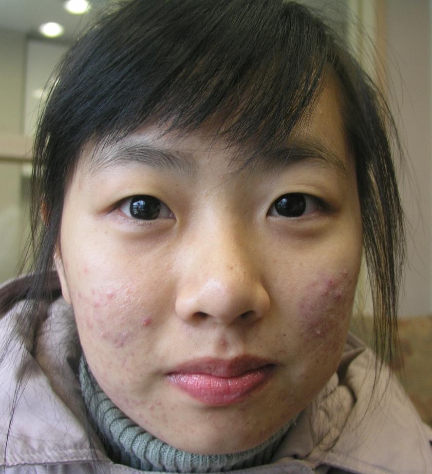 Acne redness 2 treatments @ 1