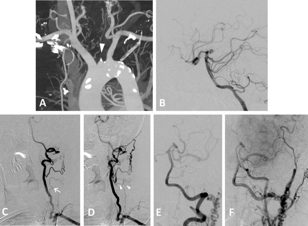 PCA Aneurysm with CCAO Fig. 3 Case 2: (A) A 3D-CT angiogram showing occlusion of the left CCA (white arrowheads). (B) Lateral view of the left VAG showing a posterior cerebral artery (P1) aneurysm.