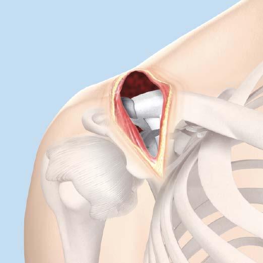 Dislocation of the Acromioclavicular Joint 2 Approach If image intensification is to be used, determine that access for the C-arm is sufficient for the anteroposterior and cephalic tilt views.