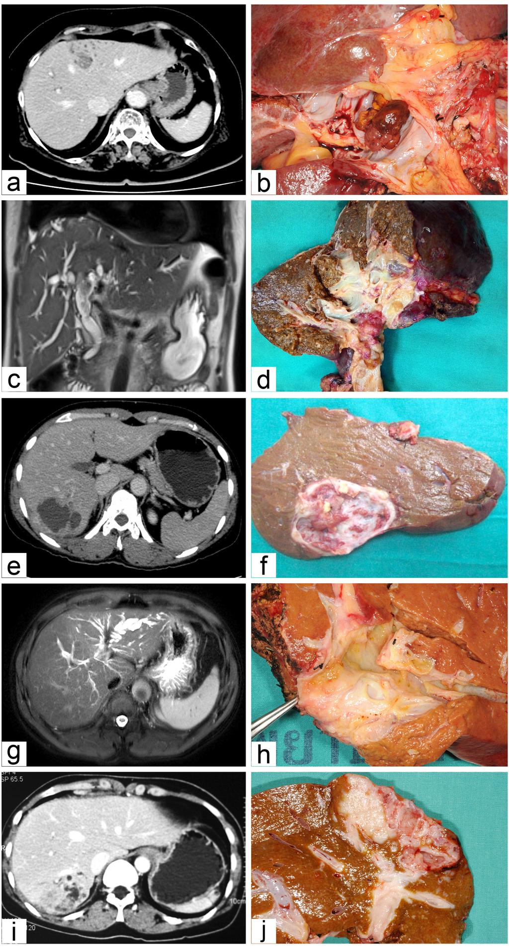 DOI:10.22034/APJCP.2017.18.1.207 Figure 1. Photograph of Preoperative Imaging and Surgical Specimens of Intraductal Papillary Neoplasm of the Bile Duct according to Class.