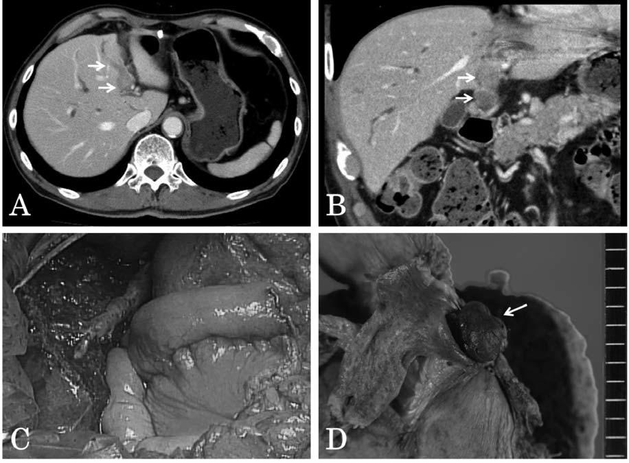 Oba et al: BDTT as a Prognostic Factor in HCC Figure 1. Left hepatectomy with bile duct resection for HCC patient with BDTT. A and B: CT scans revealed BDTT (arrows).